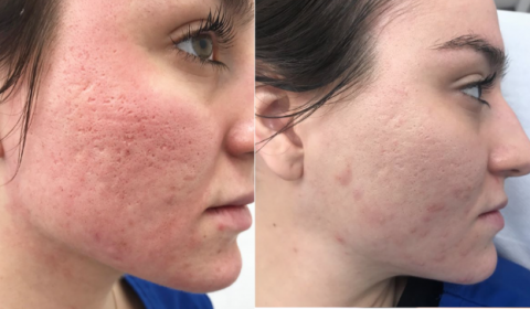 advanced skin care treatments for acne scars