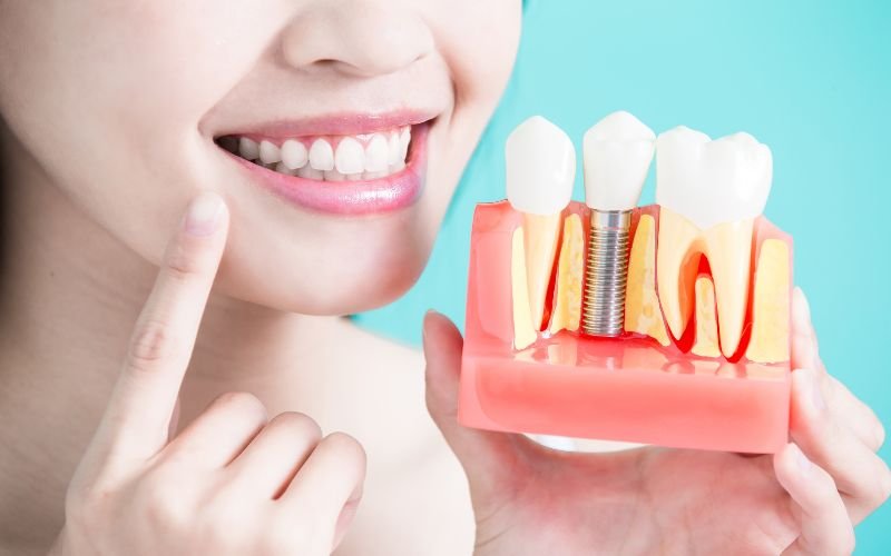 The Impact of Dental Implants on Your Overall Quality of Life