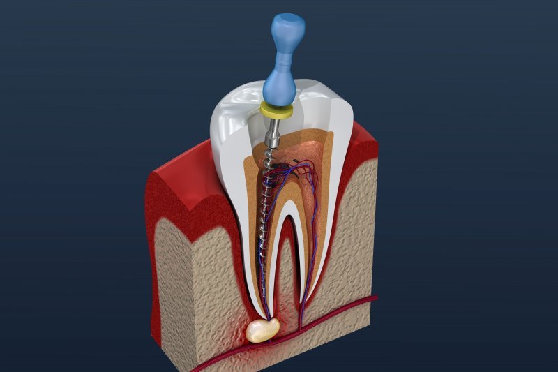 How to Avoid Needing a Root Canal