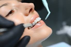 Benefits of Choosing Cosmetic Dentists for Smile Makeovers
