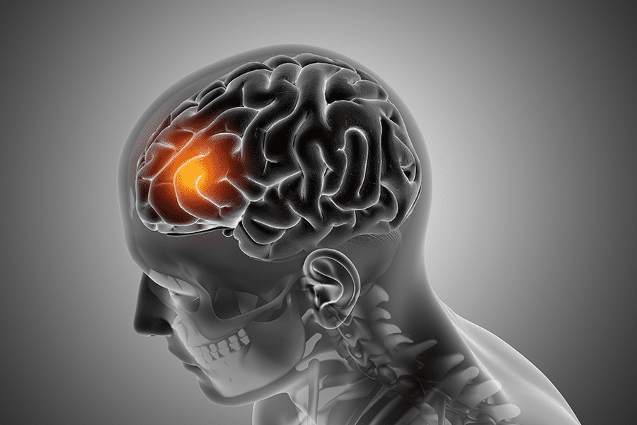 What Is Glioblastoma and How Is It Treated?