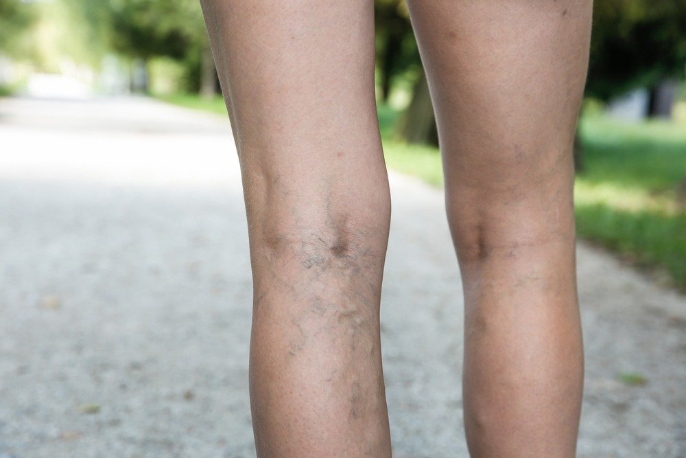 How To Identify and Treat Spider Veins