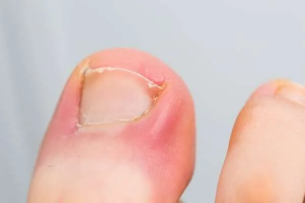 What You Need to Know About Ingrown Toenails