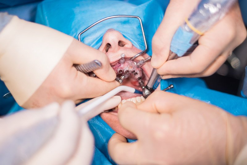 Types of Oral Surgery Procedures and When They’re Needed