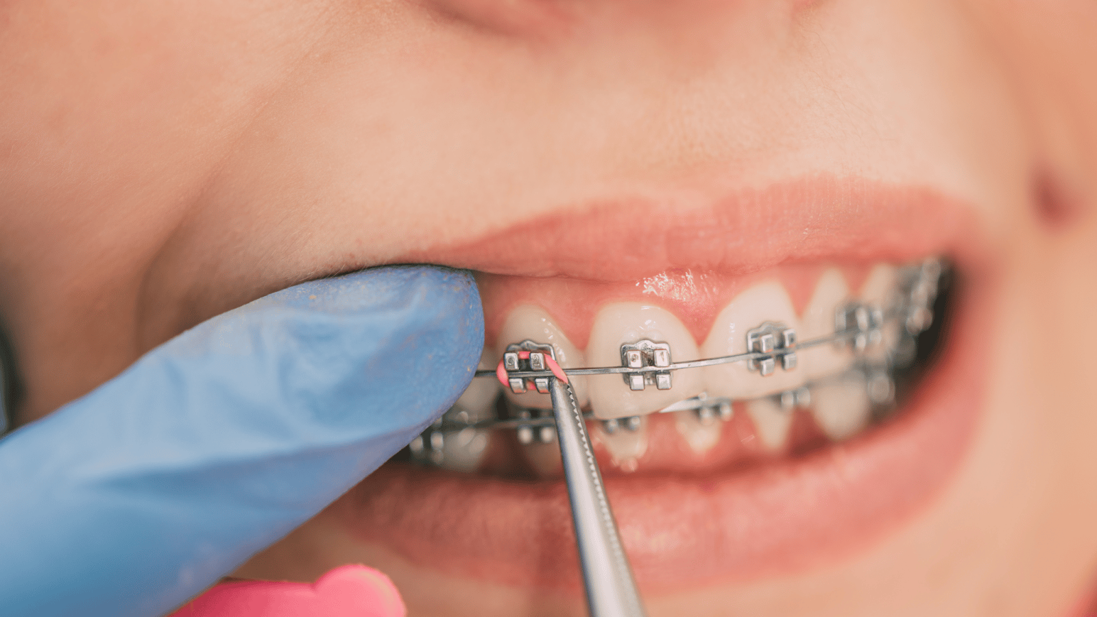 Signs Your Child Needs Orthodontic Treatment