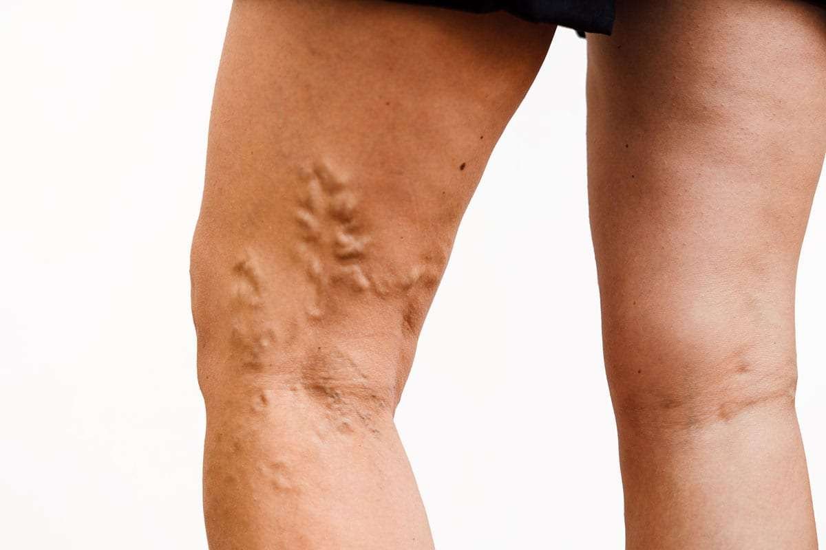 Understanding the Causes and Symptoms of Varicose Veins