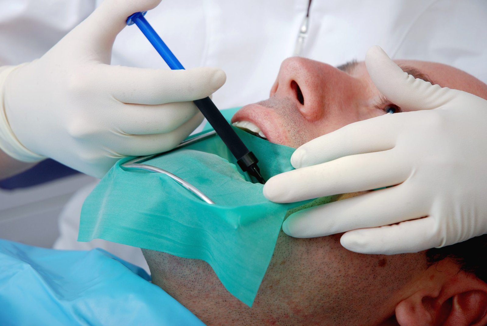 What to Expect During a Root Canal Procedure