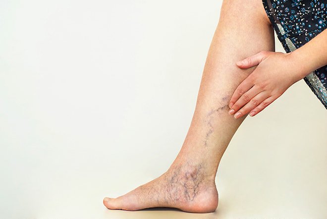 How Varicose Veins Develop and Their Impact on Your Health