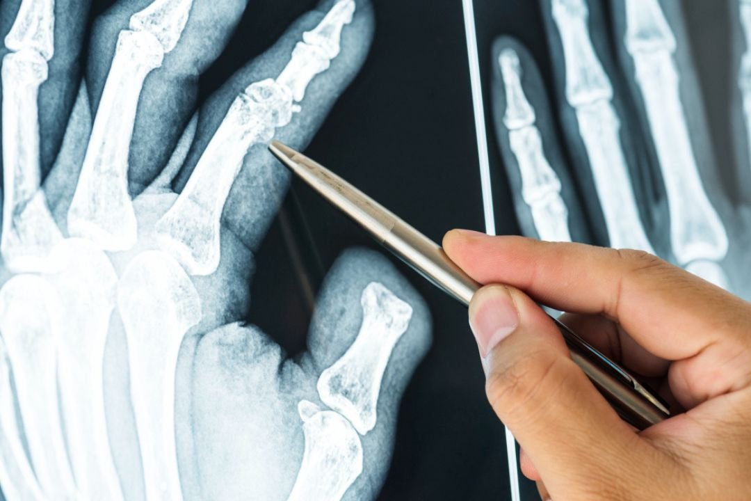 Understanding How X-Rays Aid in Diagnosing Bone Fractures