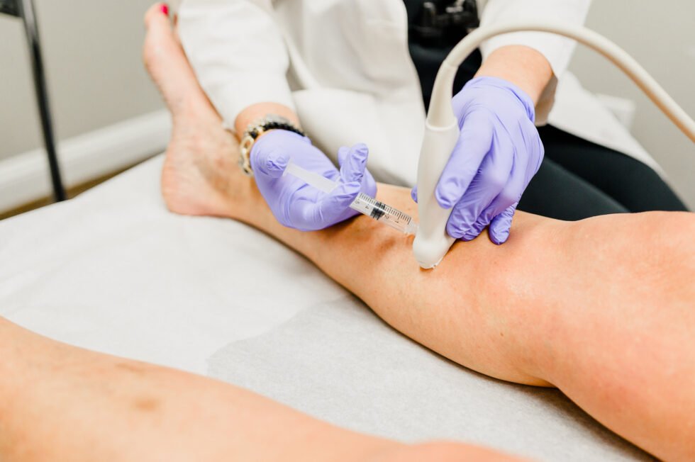 Exploring the Effectiveness of Radiofrequency Ablation in Treating Varicose Veins