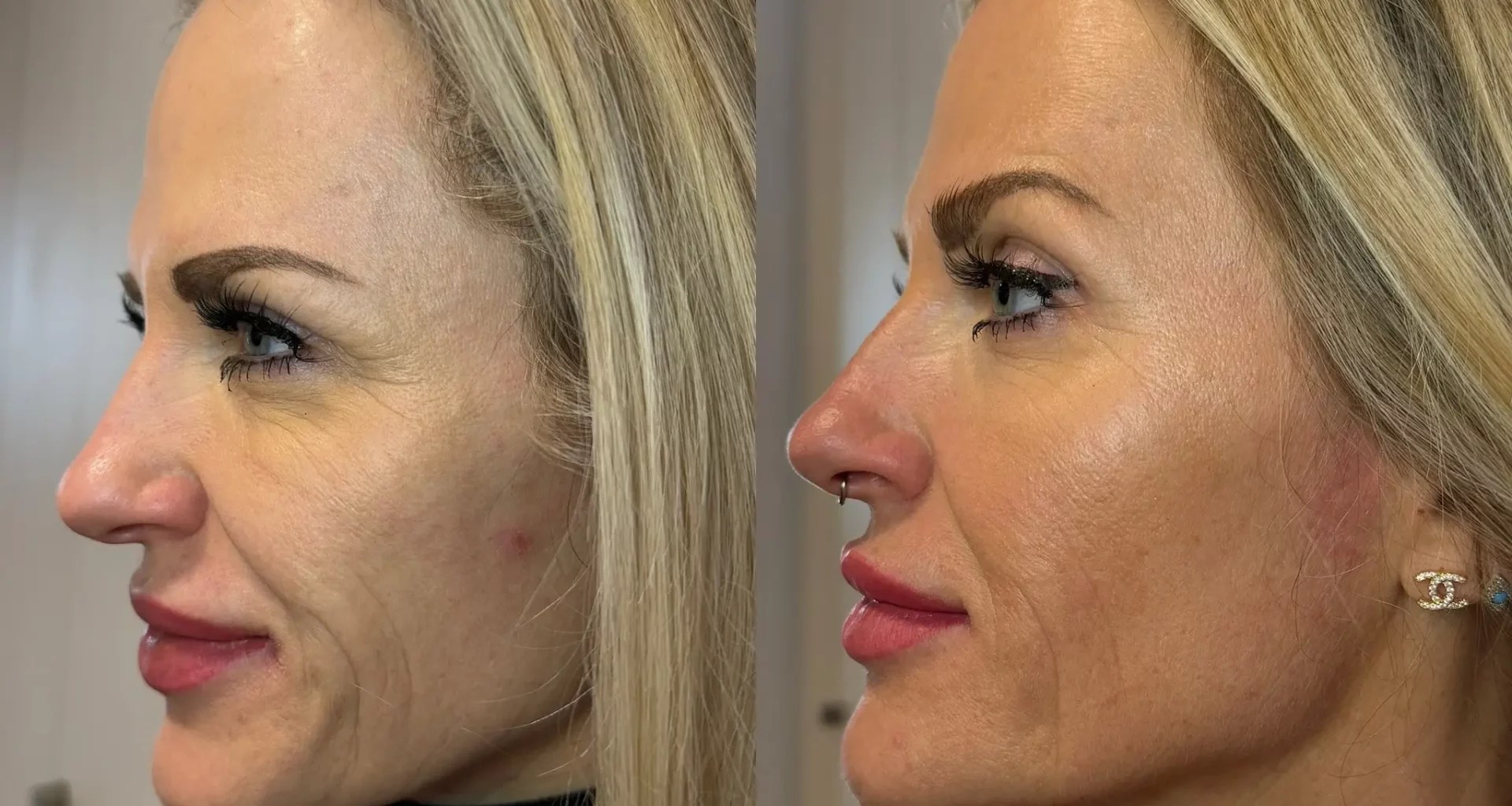 Transformative Effects of Morpheus-8 on Aging Skin