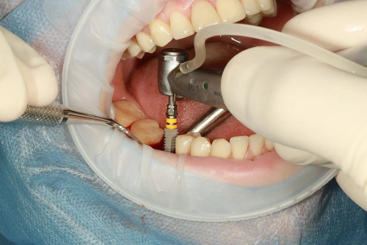 What To Expect When Getting Dental Implants