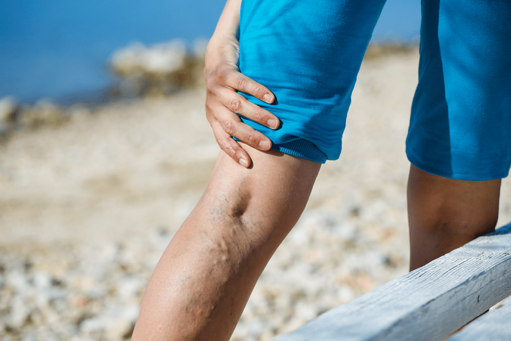 Lifestyle Changes for Managing Varicose Veins