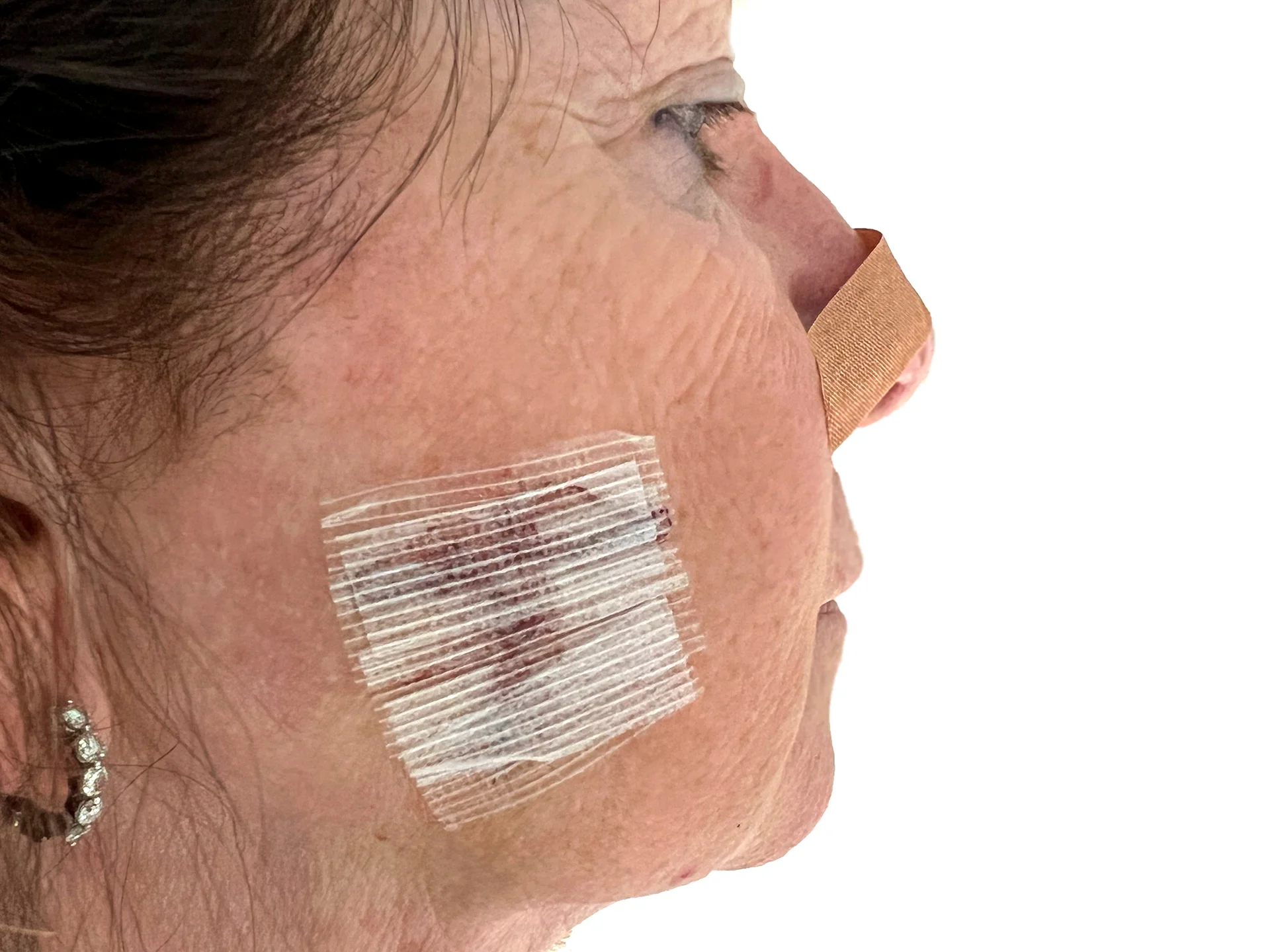 Understanding the Mohs Surgery Process and Healing