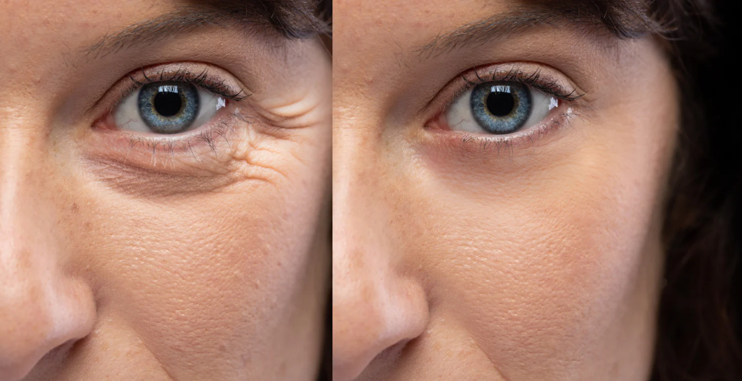 How Skin Resurfacing Addresses Fine Lines and Wrinkles