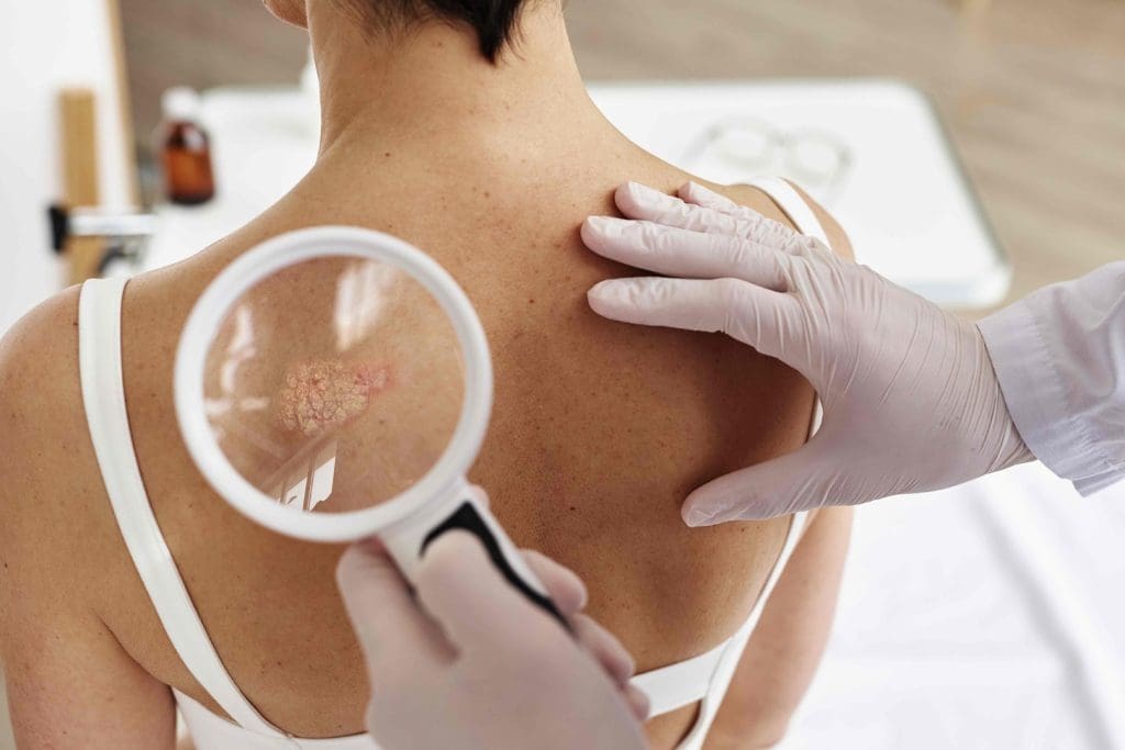 Skin Cancer Treatment Options