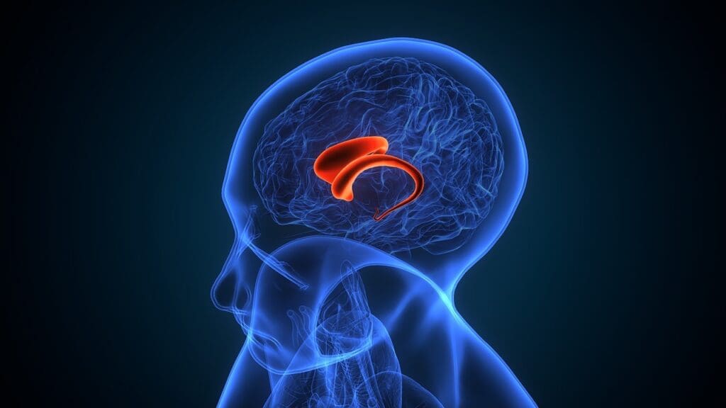 Hydrocephalus