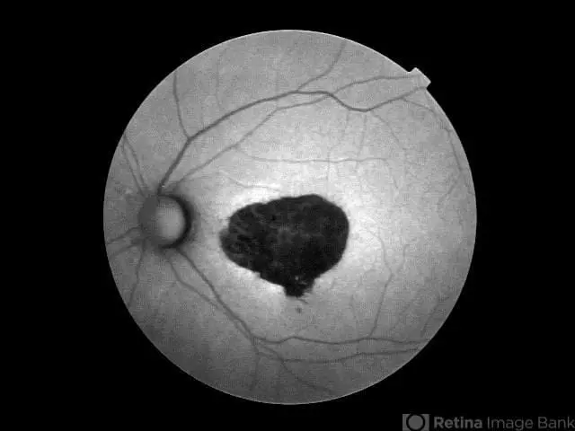 Macular Degeneration