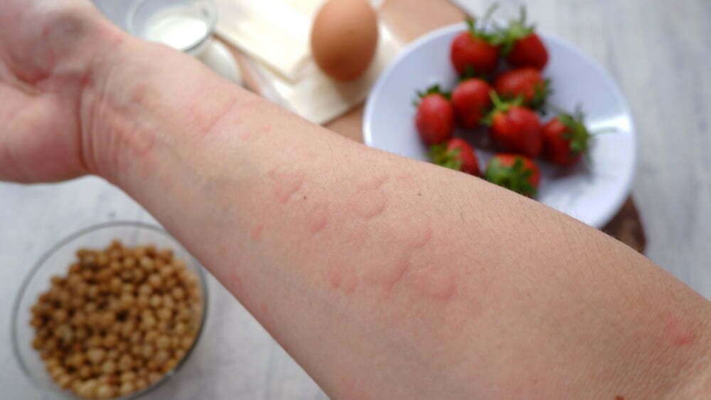 Treatment for Food Allergies